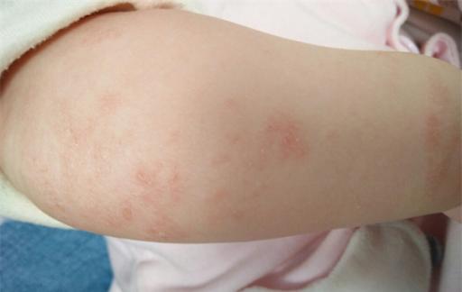 婴儿湿疹怎么处理最好 婴儿湿疹最佳治疗方法