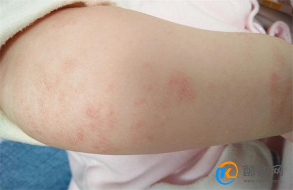 婴儿湿疹怎么处理最好 婴儿湿疹最佳治疗方法