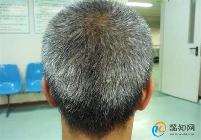 白发长在哪 病就在哪出 长在前额 两鬓 后脑勺 分别说明了啥