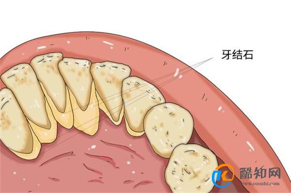 牙缝里的牙结石 能不能自己抠掉 有关洗牙的3个误区 该澄清了