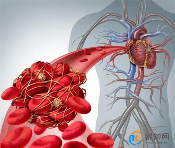 体内有血栓，手脚先知！提醒：这5种表现，提示血管可能堵塞了