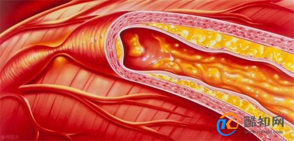 动脉硬化来临之前 会有这几个信号 或是血管变硬了 及时注意