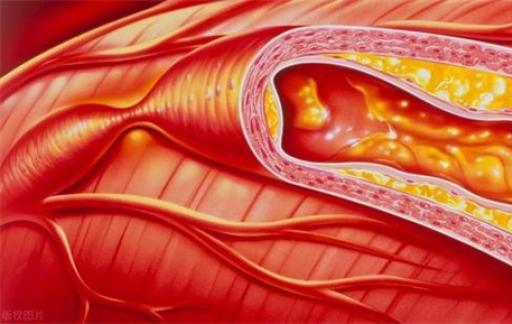 动脉硬化来临之前 会有这几个信号 或是血管变硬了 及时注意