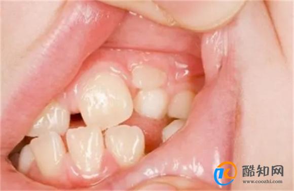 孩子嘴里都是一些“小黑牙”,不是因为糖，而是来源于家长？