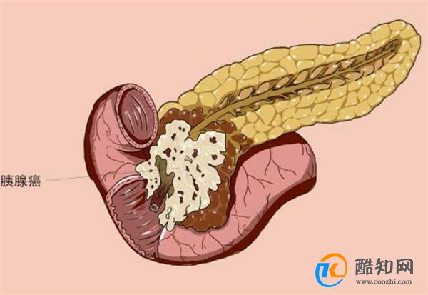 为什么胰腺癌一发现就是晚期 早期有何症状表现