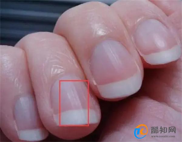 指甲盖上有竖纹 是什么原因 真是老人说的“肝脏不好”吗 