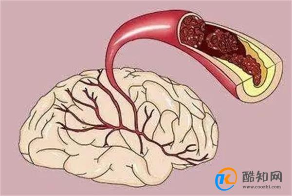 脑梗是“拖”出来的吗？睡觉时若有这3个现象，或要引起重视