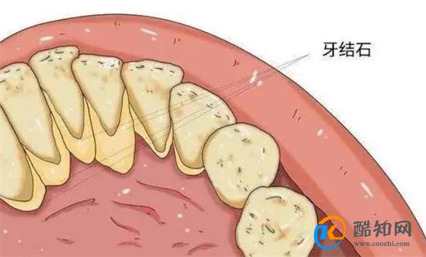 “牙结石”可以自己抠掉吗？教你几招，帮助牙缝脏东西轻松掉