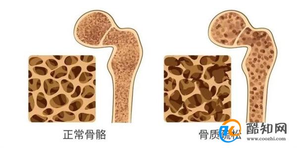 睡觉时腿抽筋是怎么回事 说明身体缺钙吗 3个原因要重视