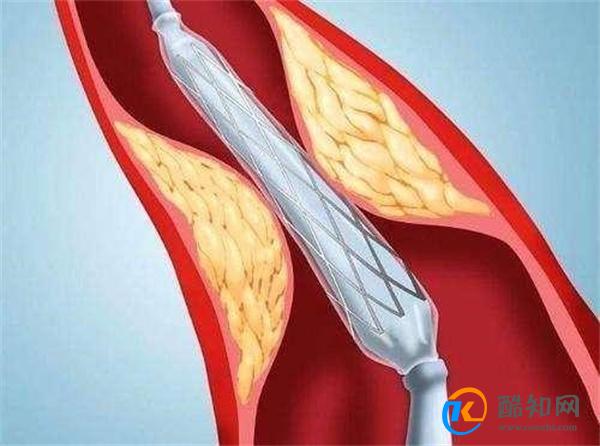 装上心脏支架后 还能活多少年 医生说出了实情 转给家人看看吧