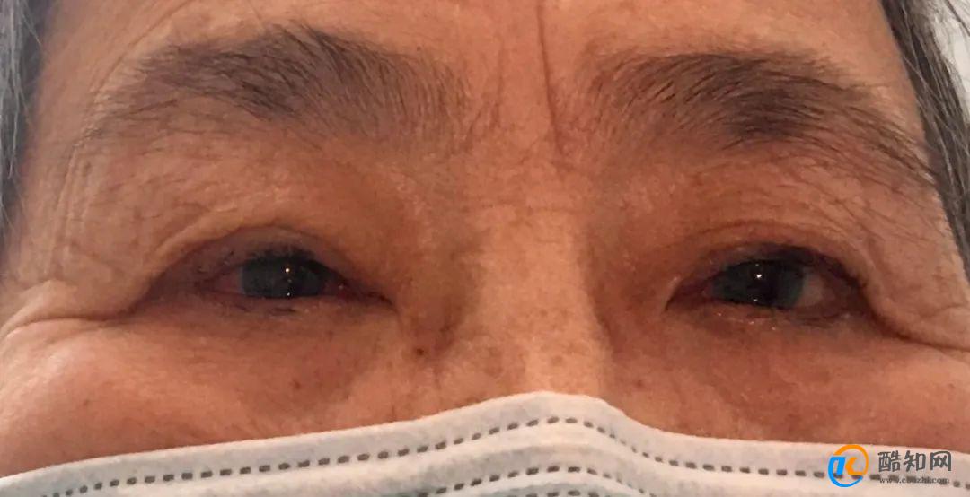 74岁老人做眼部手术死亡 死亡原因是什么