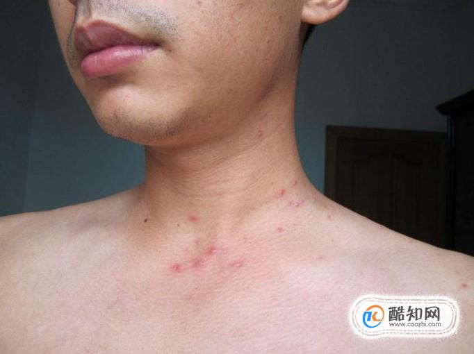 hiv感染后,一般在2-4周出现皮疹,面部,颈部,肩部,背部,腰部和四肢