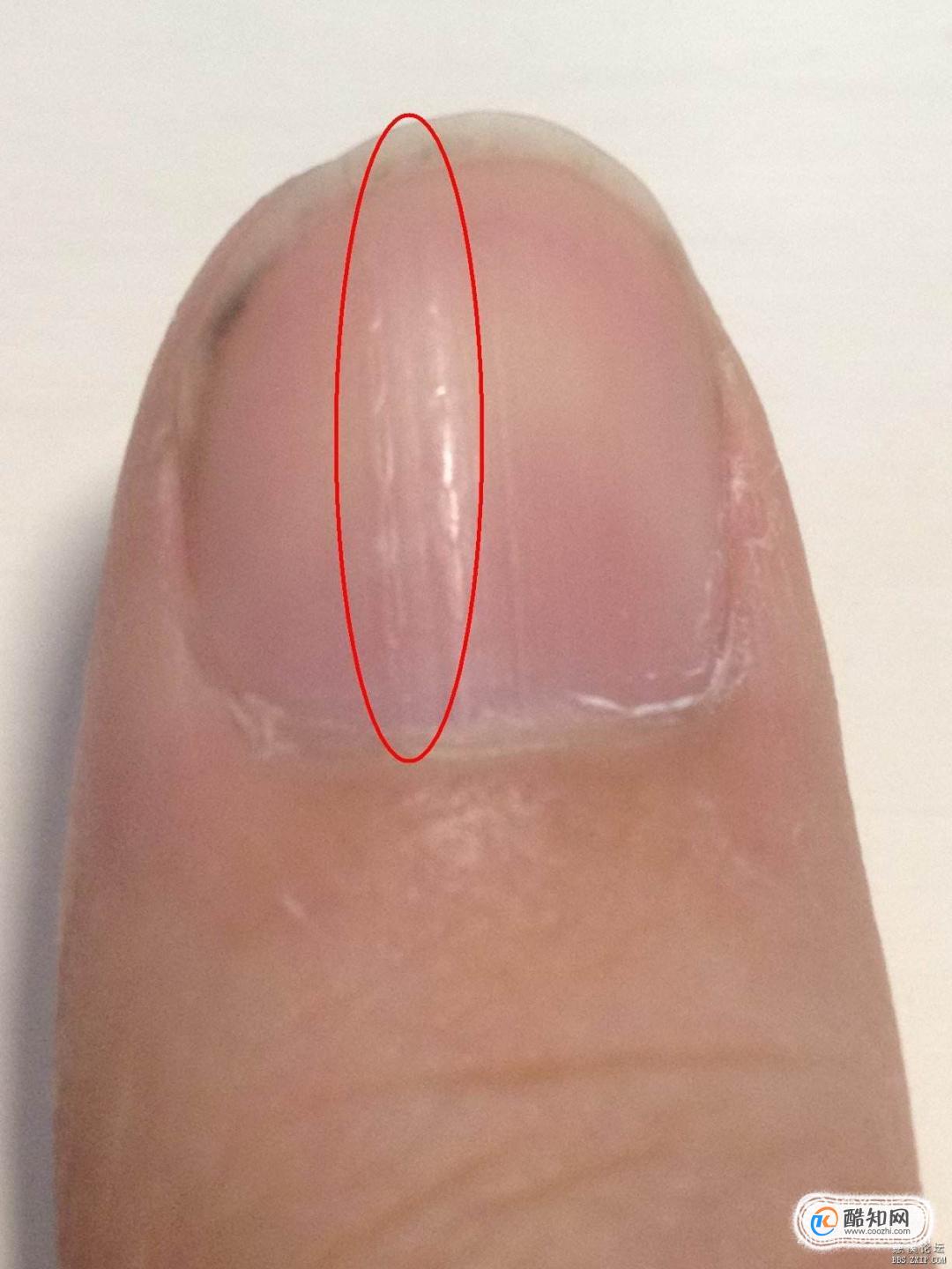 指甲横纹凹陷怎么回事,指甲上有横纹凹陷是怎么回事 - 伤感说说吧