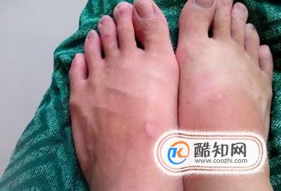 老人脚肿了怎么消肿