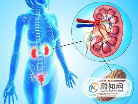 肾结石适合吃什么水果？