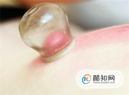 拔火罐后有哪些颜色