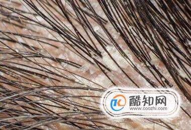 如何识别头上是否有螨虫