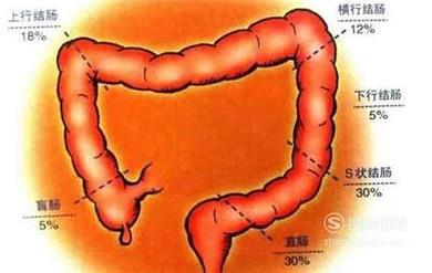 如何定义肠癌 肠癌病人吃哪些食物好