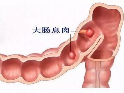 大肠息肉怎么治疗和预防，会癌变吗？