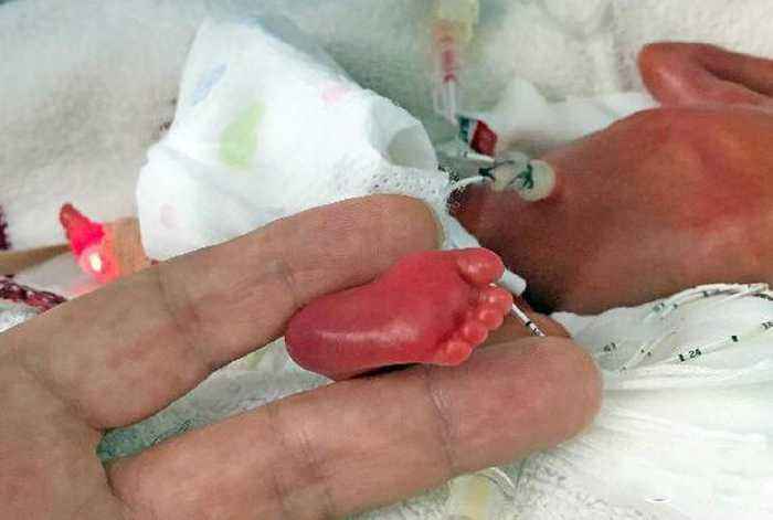 世界上最小的人类宝宝图片