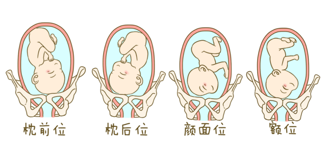 ROA胎儿姿势图片