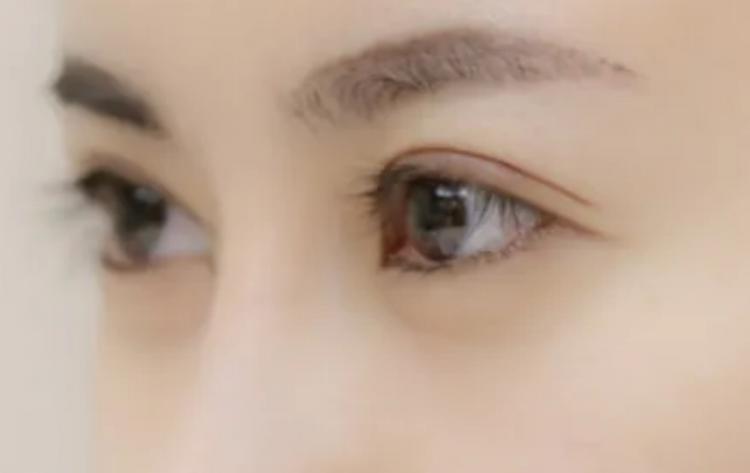 割双眼皮恢复期应该注意什么？