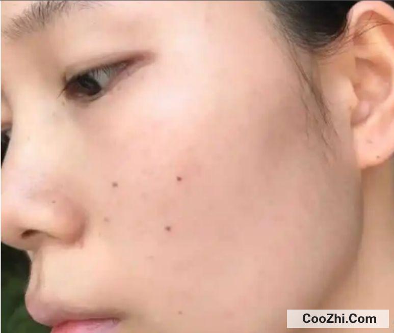 用了水杨酸脸颊泛红怎么补救