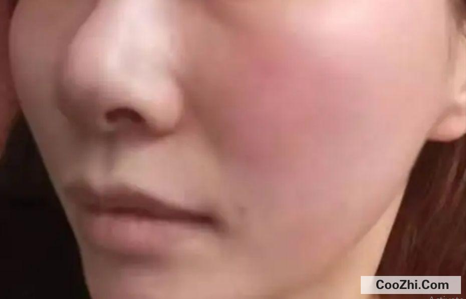 用了水杨酸脸颊泛红怎么补救