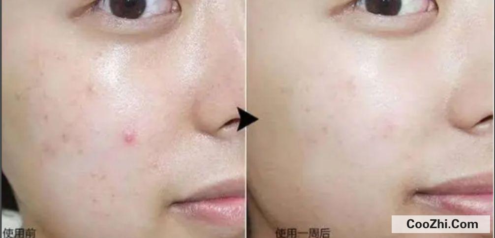 用了水杨酸脸颊泛红怎么补救