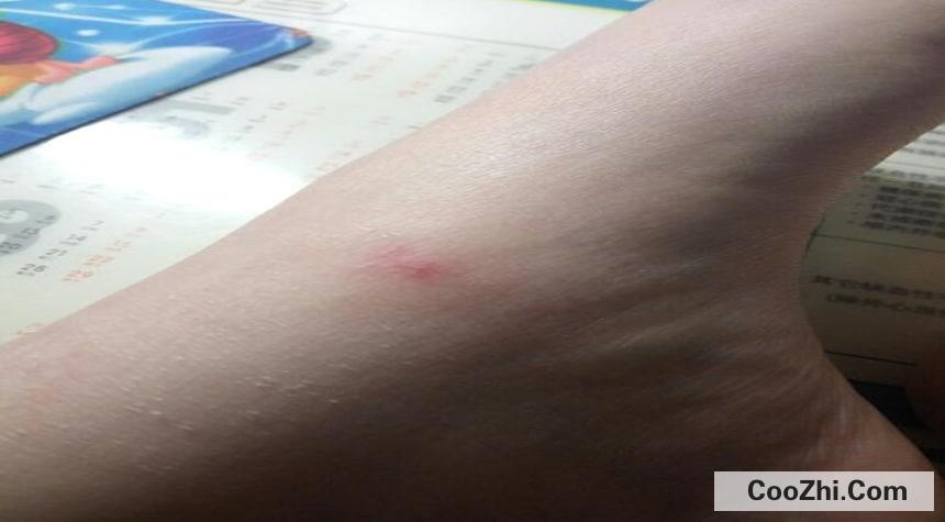 蚂蚁咬到肿了怎么办