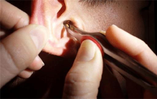 耳屎是怎么保护耳朵的