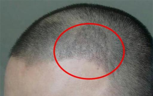 植发的危害和后遗症有哪些