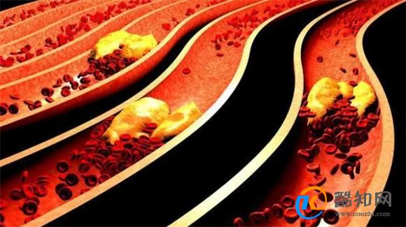 血脂报告中的胆固醇和甘油三酯是哪个危害更大，用药有什么不同？