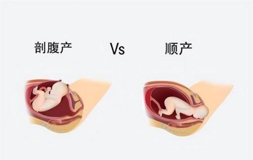 顺产还是剖宫产  没有哪个更轻松 带你一起了解下