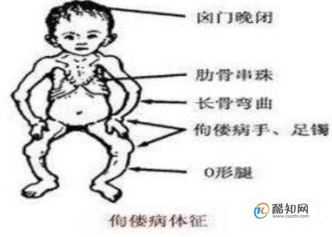 什麼是維生素d缺乏性佝僂病優質