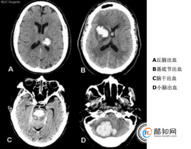 教你看头颅ct片优质