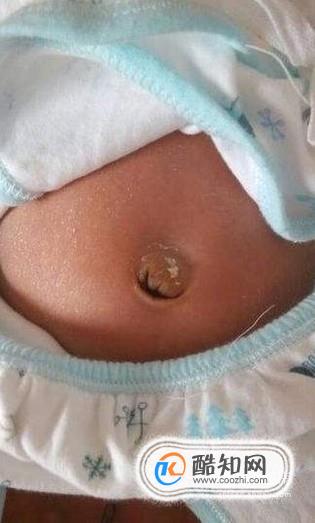 早产儿脐疝图片