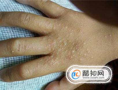 01汗疱疹:是一种皮肤病,在夏天的时候病发的可能性比较大
