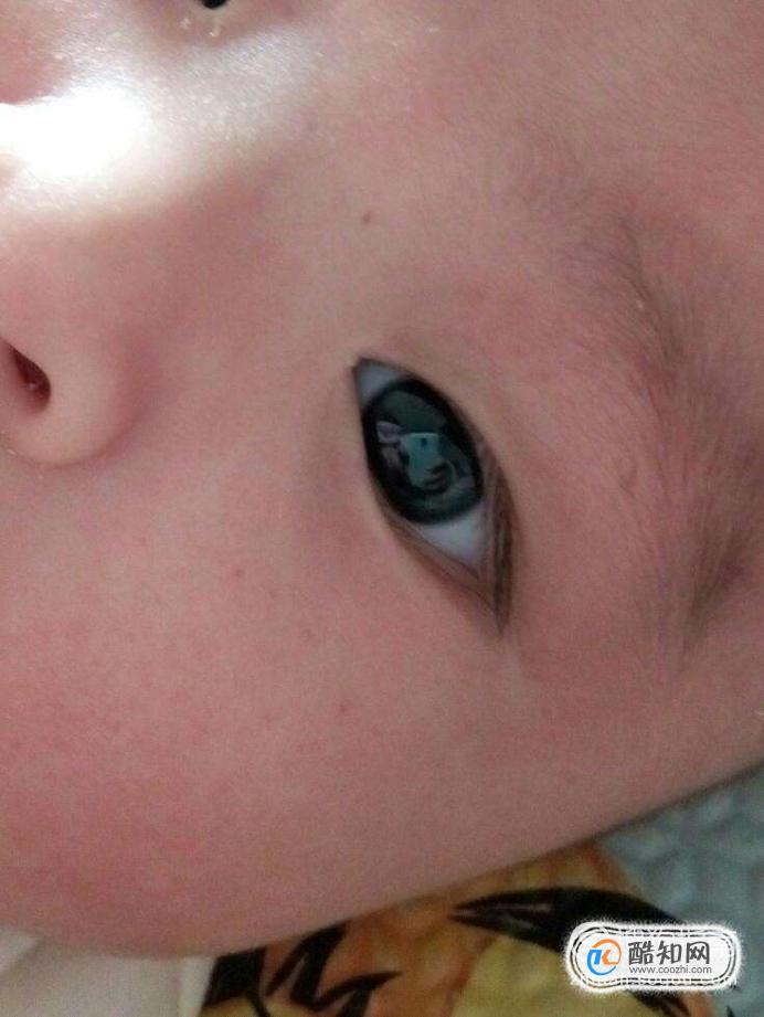 儿童眼部紫癜初期症状图片
