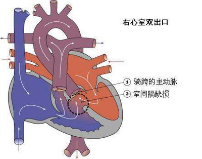 肺动脉吊带是什么意思?